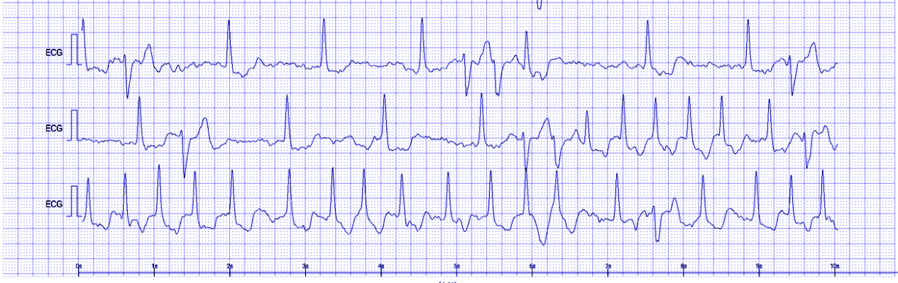 ЭКГ пациента - героя статьи - при нарушении ритма, которое он сам фиксировал портативным кардиорегистратором